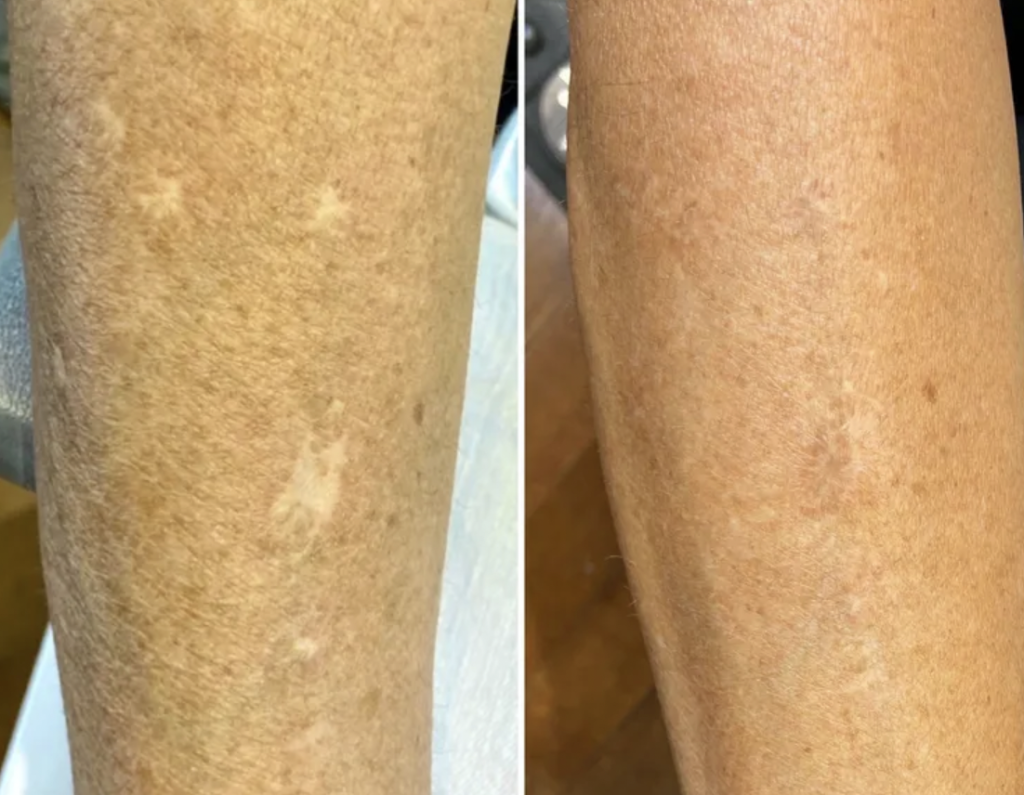 Scar Camouflage with Micropigmentation  Complete Guide