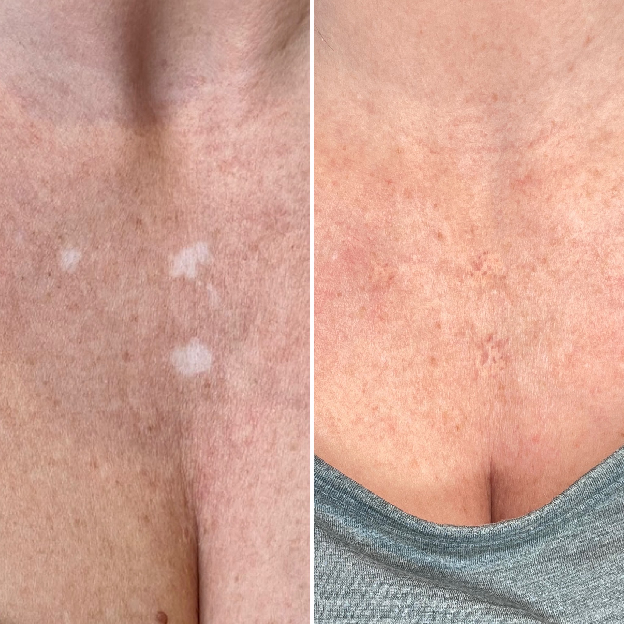 Stretch Mark Micropigmentation Chicago | Scar Camouflage Chicago & Stretch  Mark Camouflage Chicago