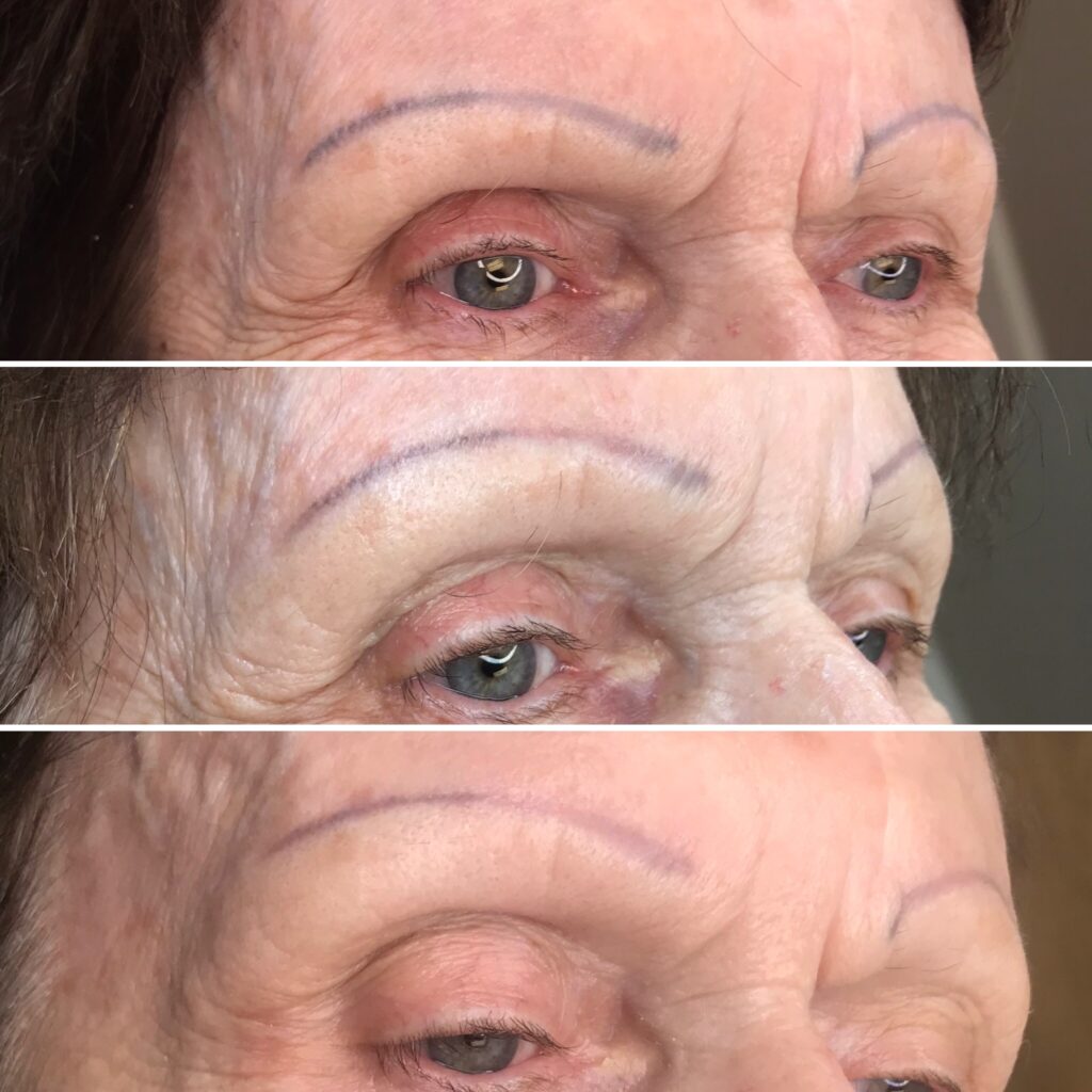 Permanent Makeup Tattoo Removal by Toronto Novaline Cosmetcs