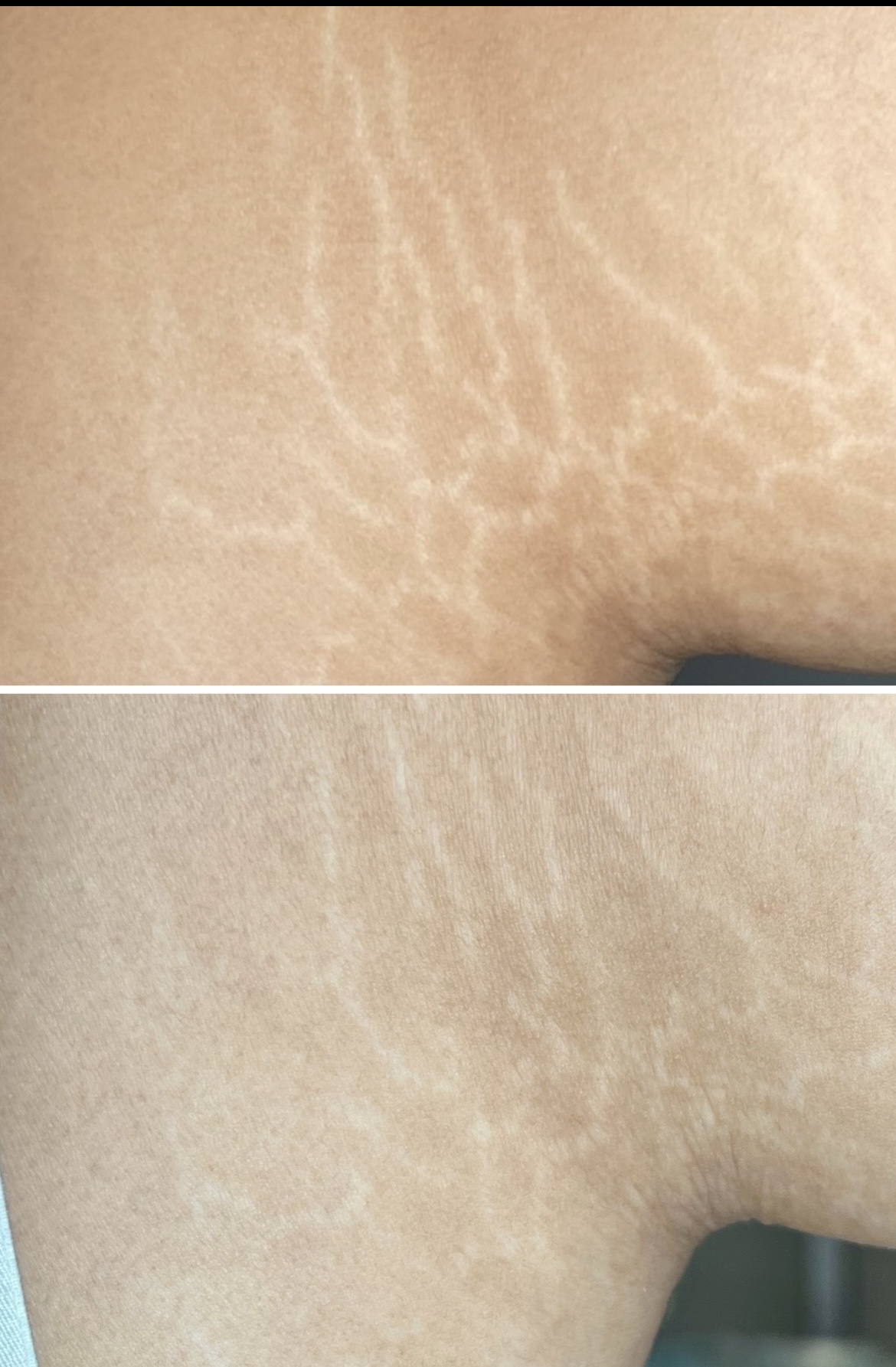 Stretch Mark Revision - Housley Institute