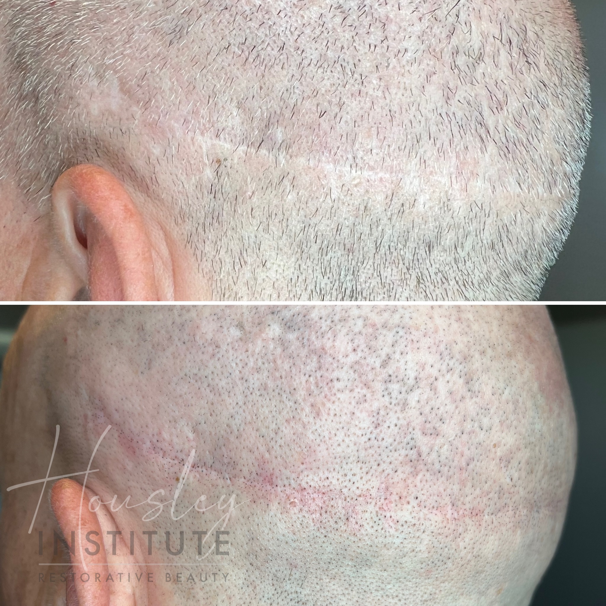 Lipo Scar Camouflage ! Call today to start your treatments or register, Remove Scar Mark